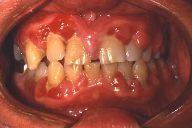 Diabetes Mellitus